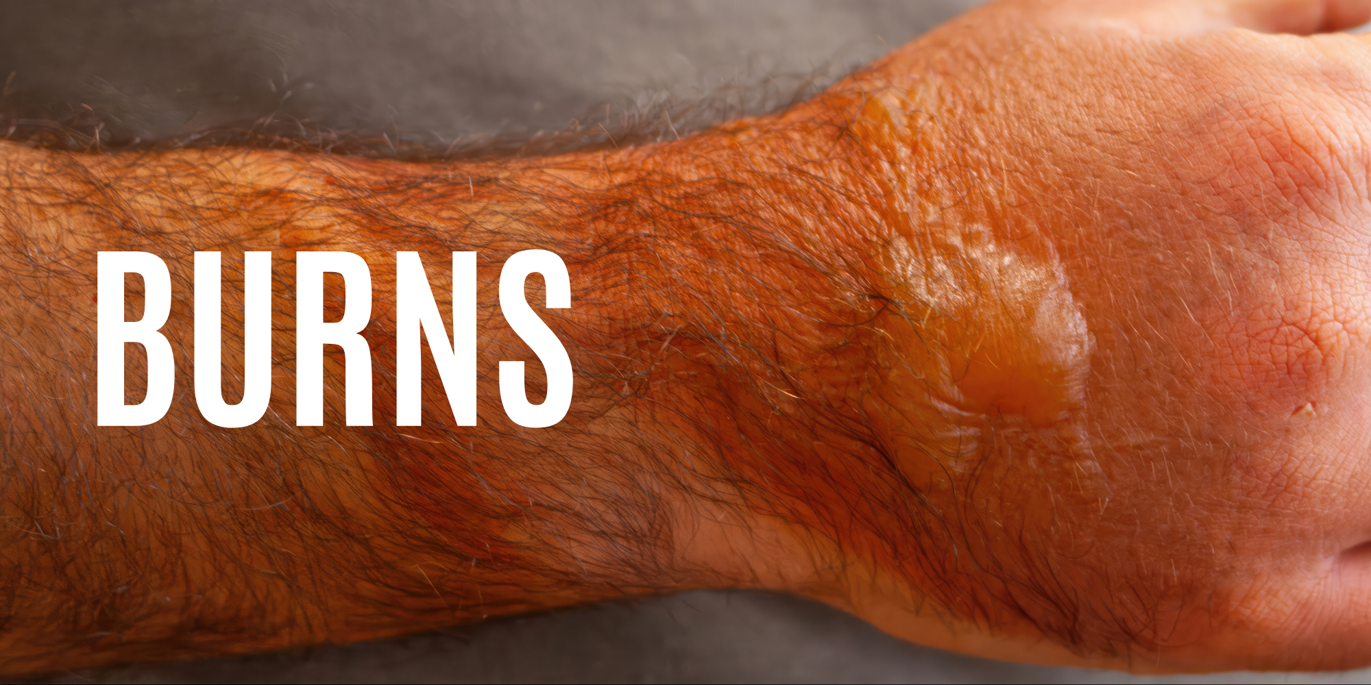 What Everyone Should Know About Burn Injuries